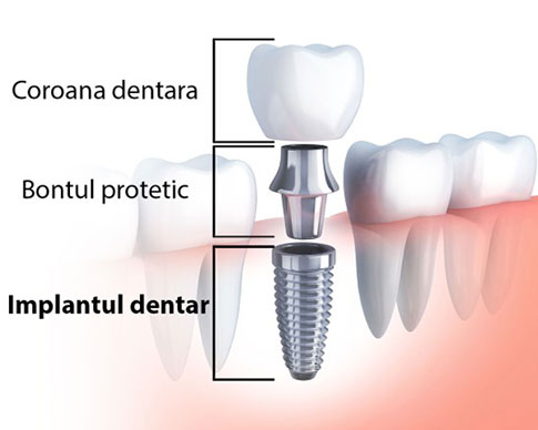 implant dentar Bucuresti
