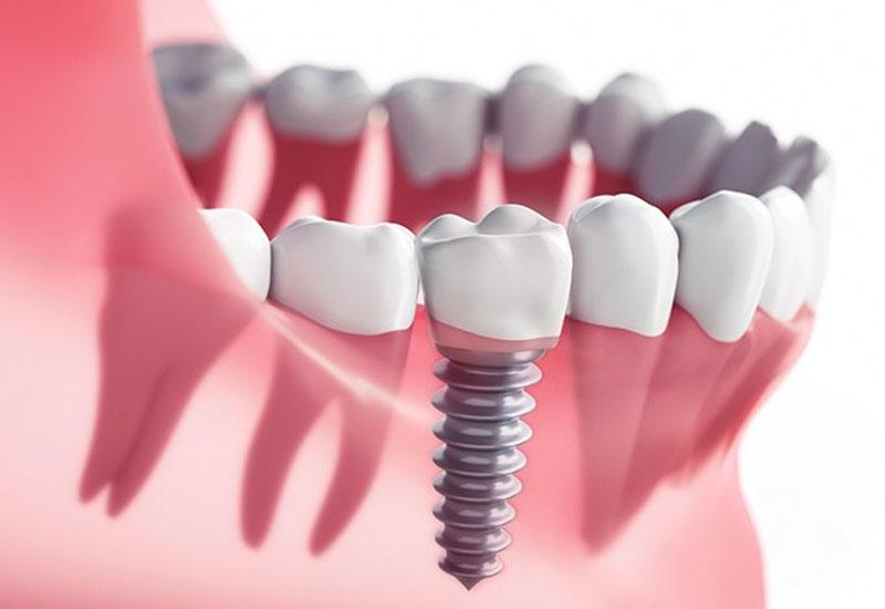 implant dentar Bucuresti
